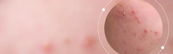 Acne & Breakouts