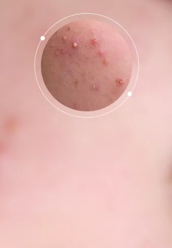 Acne & Breakouts