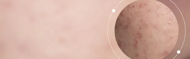 Acne Marks
