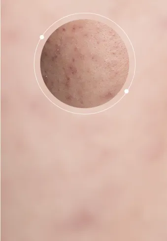 Acne Marks