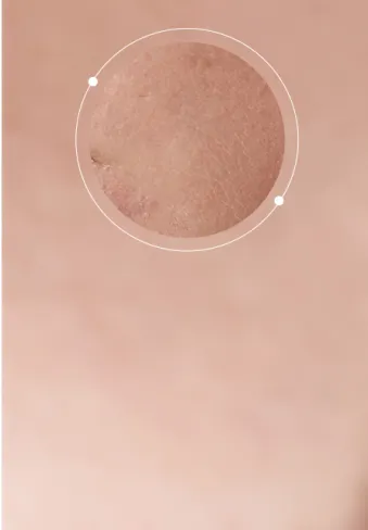 Dry Skin