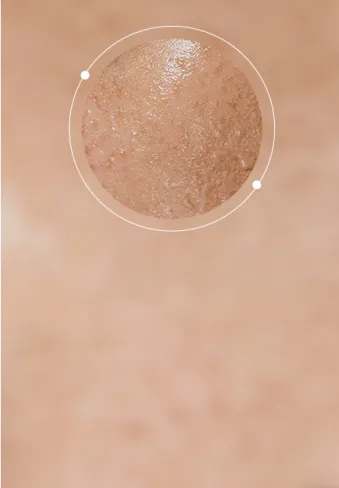 Oily Skin