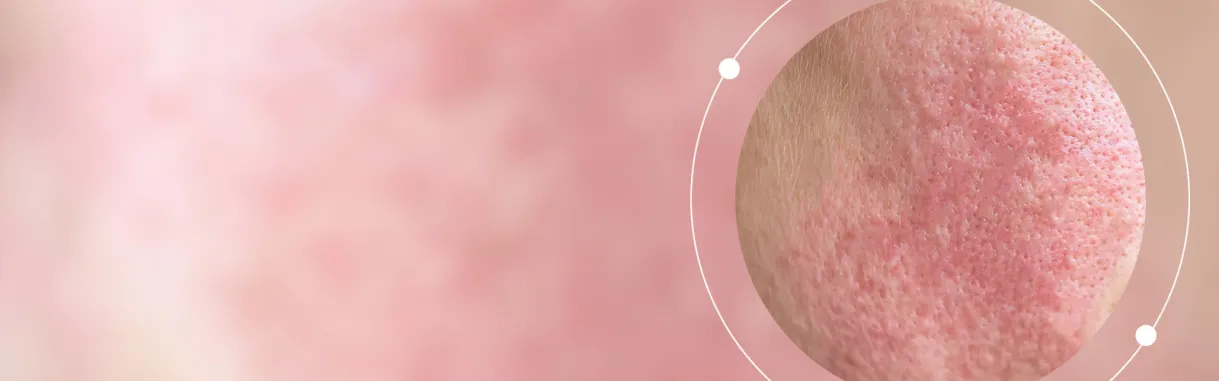 Redness / Rosacea