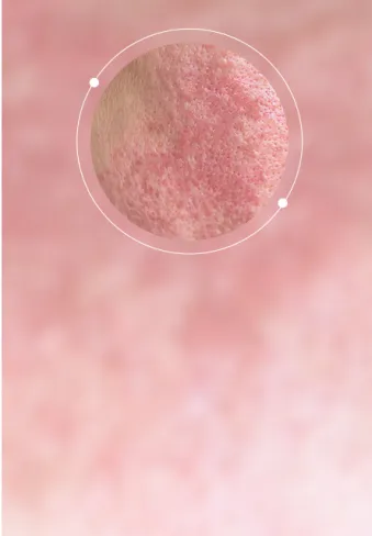 Redness / Rosacea
