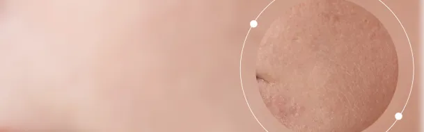Dry Skin
