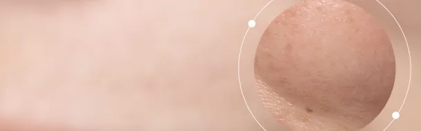 Normal Skin